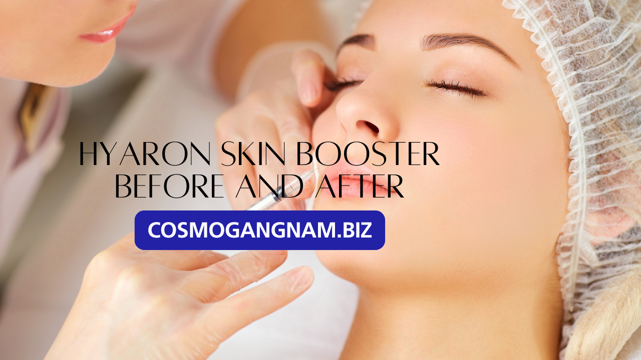 Hyaron Skin Booster Before and After